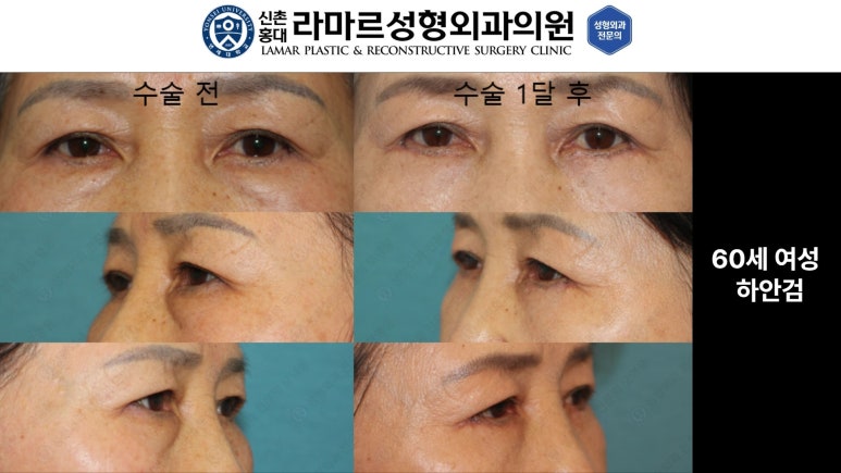 30대~80대 눈 수술 케이스 : 하안검성형술 전후 사진 모음 관련 이미지 23