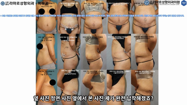 '복부성형술+지방흡입(Abdominoplasty+PAL)' 으로 뱃살 끝장내기! 관련 이미지 51