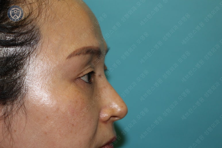 49세 여성, 토안이 있는 중년여성의 상안검성형술 (49/F, Upper blepharoplasty with lagophthalmos correction& LP) 관련 이미지 9