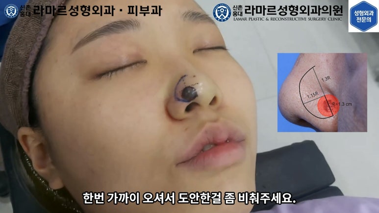 지름 1cm 코 점 제거수술 : 나선피판술(Spiral Flap) 수술전~1달 경과. (Feat. 턱끝필러+사각턱 보톡스) 관련 이미지 50