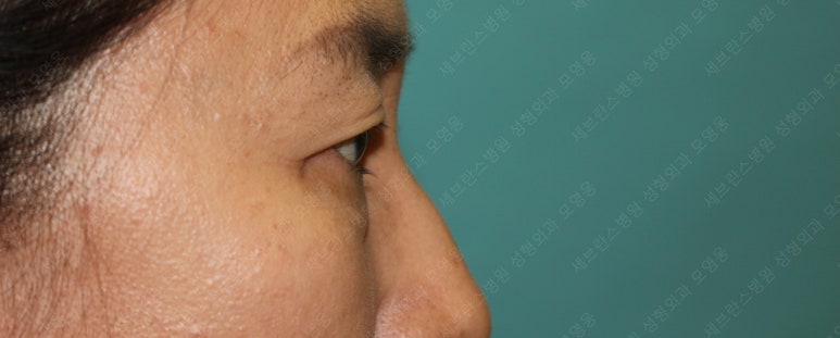 55세 여성, 상안검 및 하안검 성형술 증례 (55/F Upper & lower blepharoplasty) 관련 이미지 8