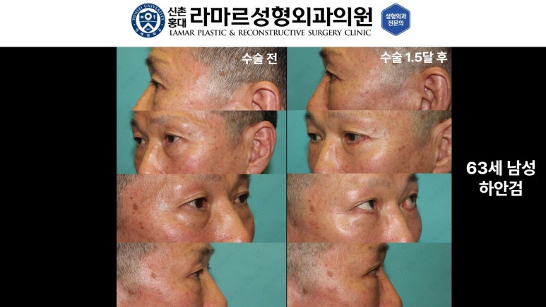 30대~80대 눈 수술 케이스 : 하안검성형술 전후 사진 모음 관련 이미지 32