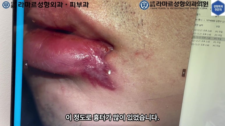 개에 물려 입술 1/3이 뜯긴 19세 남자분 치료 및 흉터 성형수술& 레이저 후기....! 관련 이미지 26