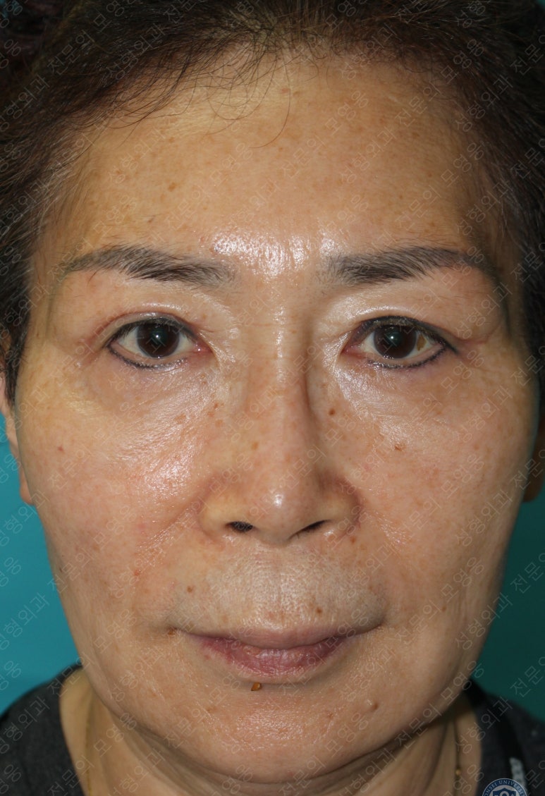 64세 여성 상안검성형술+눈매교정 (64/F Upper blepharoplasty with ptosis correction) 관련 이미지 18