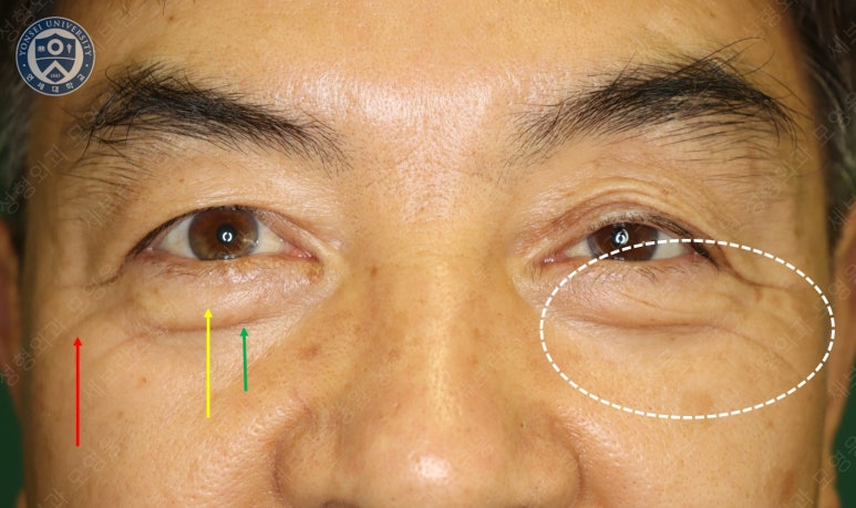 68세 남성, 하안검 성형술 및 안검외반 교정 증례(68/M Lower blepharoplasty & Ectropion correction with triamcinolone) 관련 이미지 5