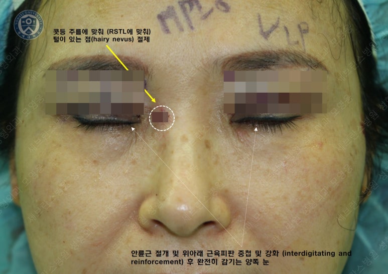 49세 여성, 토안이 있는 중년여성의 상안검성형술 (49/F, Upper blepharoplasty with lagophthalmos correction& LP) 관련 이미지 13
