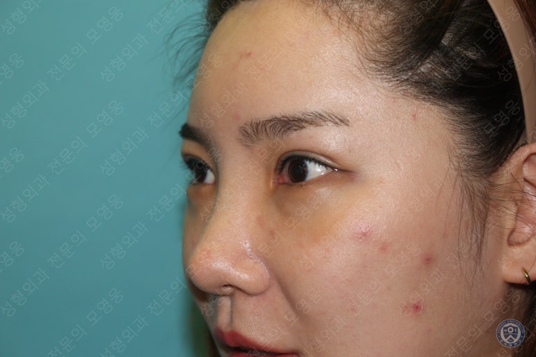 28세 여성 두줄따기, 눈밑지(28/F D.E.O & transconjunctival septal fat redraping) 관련 이미지 15