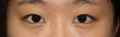 17세 여성, 쌍꺼풀+앞트임(DEO+Medial epicanthoplasty) 관련 이미지 9