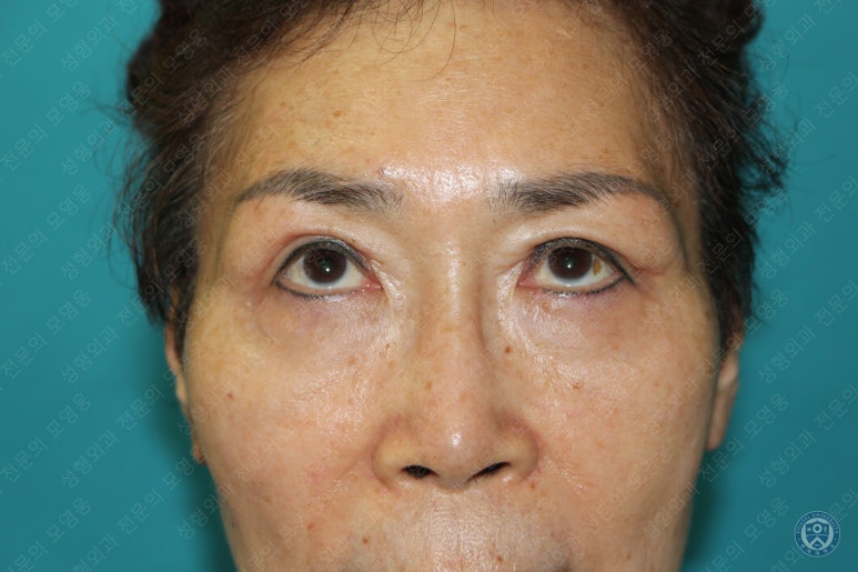 64세 여성 상안검성형술+눈매교정 (64/F Upper blepharoplasty with ptosis correction) 관련 이미지 21