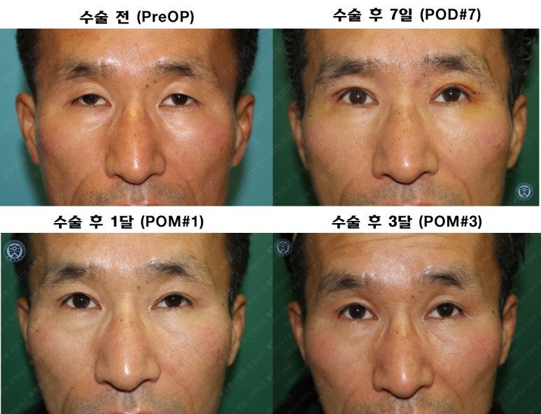 남자눈성형: 무쌍눈매교정 (Blephroptosis correction-levator aponeurosis advancement) 관련 이미지 48