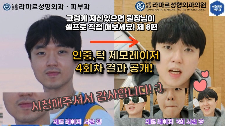 [성형외과 전문의의 셀프시술 제8편] 인중, 아래턱 제모 4회차 결과 공개! 관련 이미지 166