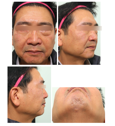 57세 남성, 얼굴 전체골절(57/M Panfacial bone fracture) 수술 및 흉터관리 증례 관련 이미지 18