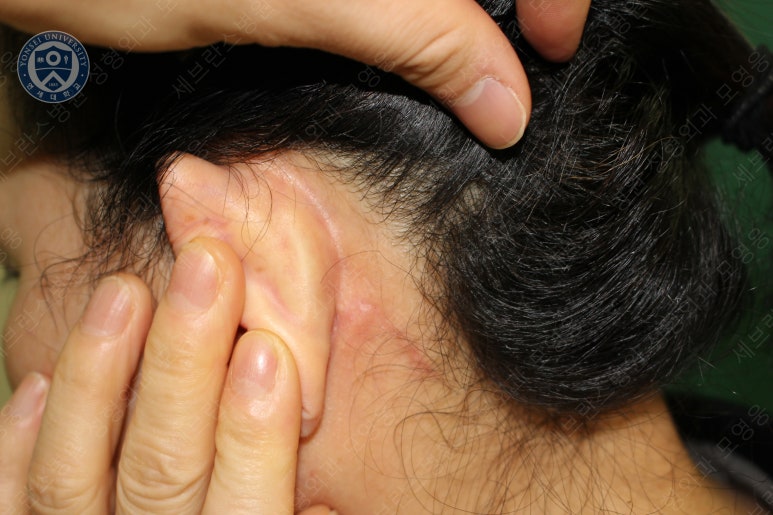 55세 여성, 이중평면 안면거상(55/F, Dual-plane full facelift) 관련 이미지 58