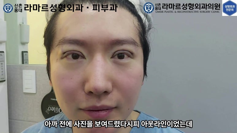 29세 남자, 소시지 쌍꺼풀 두줄따기로 낮추기 (쌍꺼풀 재수술) 관련 이미지 58