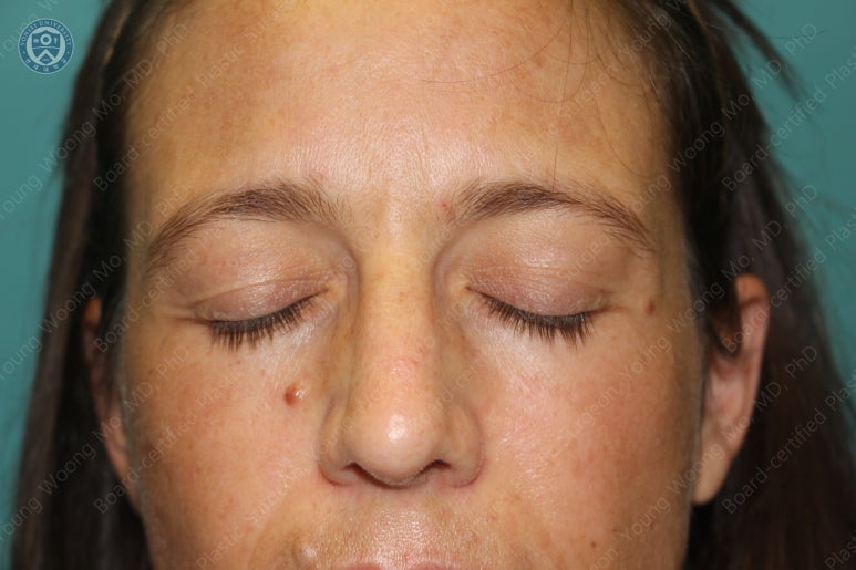 38세 서양 백인 여성, 쌍꺼풀 수술과 눈매교정 및 하안검성형술 (38/F Upper&lower blepharoplasty with levator plication) 관련 이미지 4