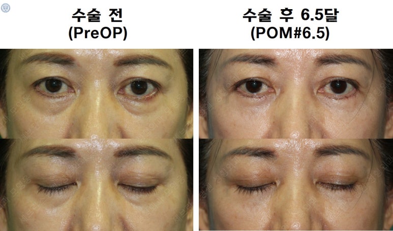 59세 여성, 그레이브스 안병증이 있는 돌출눈 중년 여성 하안검 성형술 (Lower blepharoplasty in Graves 관련 이미지 42