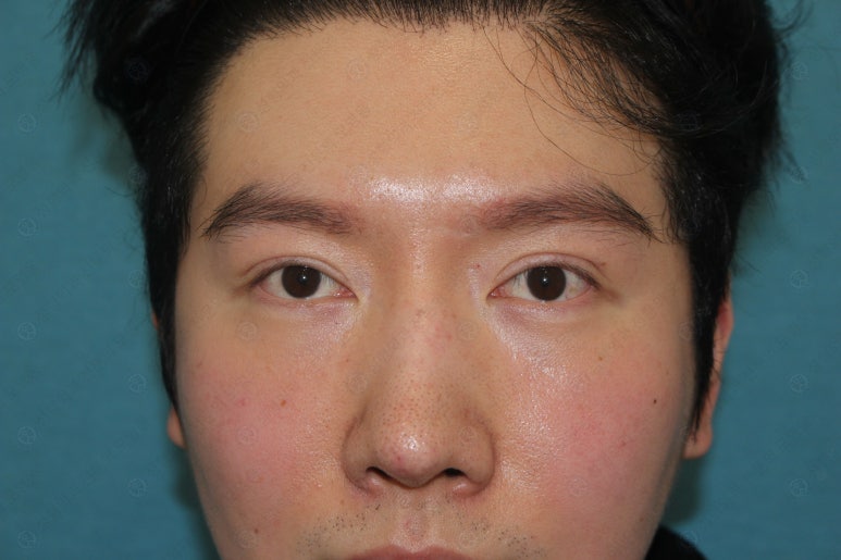 29세 남자, 소시지 쌍꺼풀 두줄따기로 낮추기 (쌍꺼풀 재수술) 관련 이미지 13