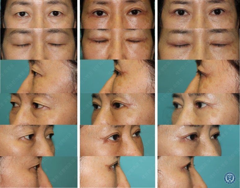 55세 여성, 상안검 및 하안검 성형술 증례 (55/F Upper & lower blepharoplasty) 관련 이미지 32