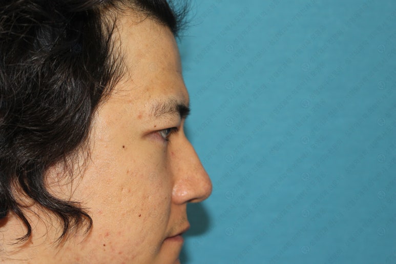 27세 남성 무쌍(속쌍)눈매교정 (27/M Ptosis correction with double lid plasty) 관련 이미지 28