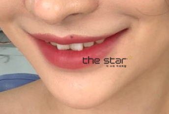 나비치아, 토끼 이빨 안 예쁜 앞니는 더스타치과 맞춤 라미네이트 관련 이미지 2