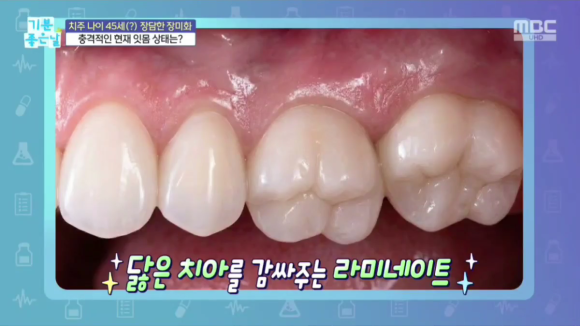 강남 라미네이트 치과추천, 마모된 치아 기능 살리는 심미보철치료 관련 이미지 7