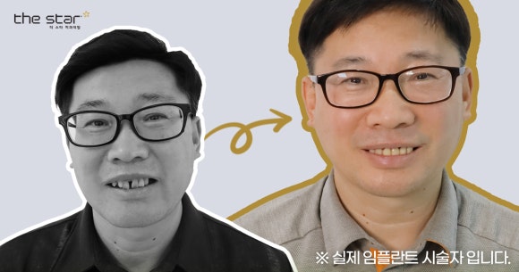 Gangnam Sinsa Station, Incisionless Implants: What Is the Secret to Minimizing Pain&middot;Swelling While Achieving High Satisfaction? image 15