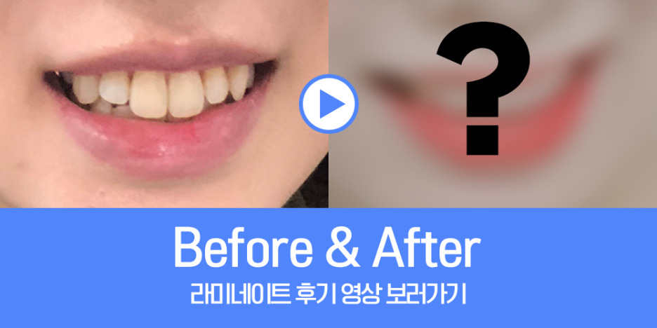 신사동 프리미엄 라미네이트 디테일 치료 과정 고민이시라면 더스타치과로 관련 이미지 1