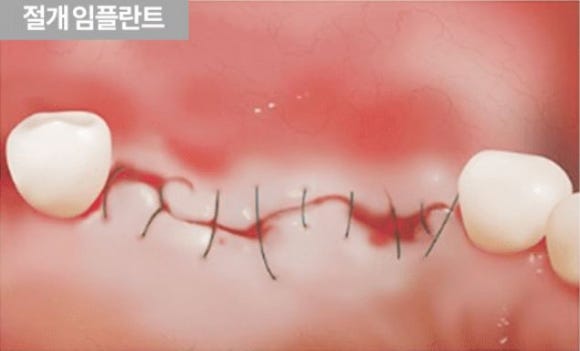 Gangnam Sinsa Station, Incisionless Implants: What Is the Secret to Minimizing Pain&middot;Swelling While Achieving High Satisfaction? image 7