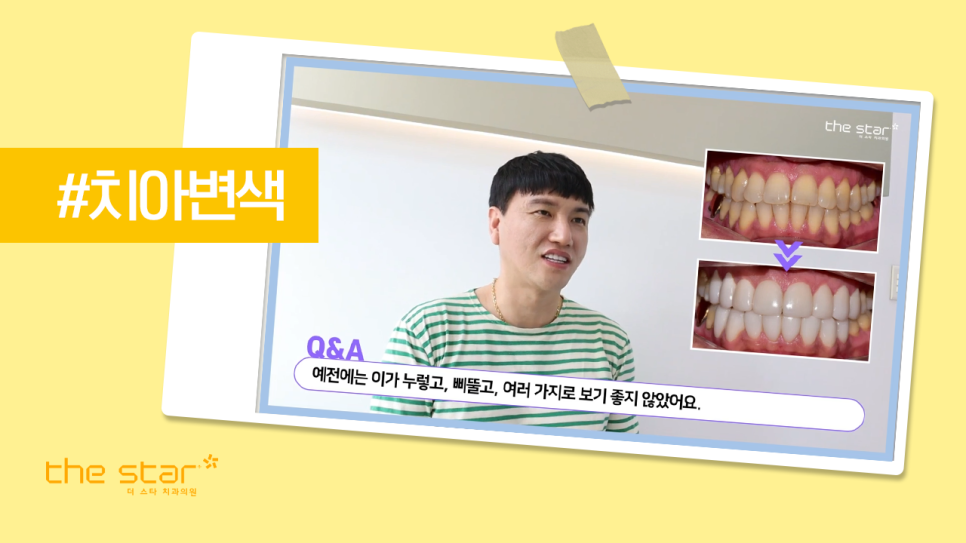 신사동 프리미엄 라미네이트 디테일 치료 과정 고민이시라면 더스타치과로 관련 이미지 5