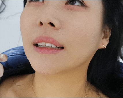 압구정 최소삭제 라미네이트, 치아 삭제 없이 앞니 틈 왜소치 개선하는 기준 관련 이미지 5