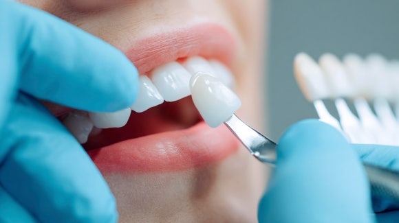 Where Can I Get Good Dental Laminates in Gangnam? image 8