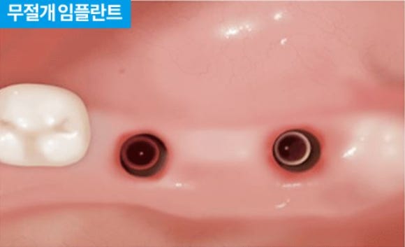 Gangnam Sinsa Station, Incisionless Implants: What Is the Secret to Minimizing Pain&middot;Swelling While Achieving High Satisfaction? image 9