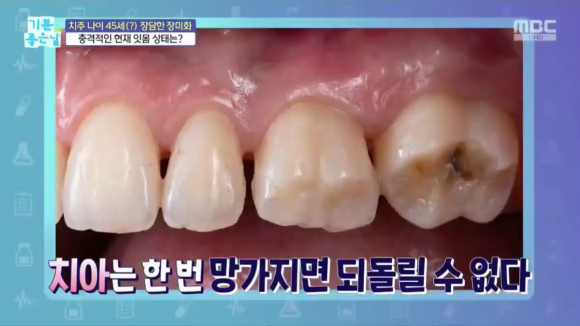 신사역 스케일링의 중요성, 잇몸치료 미루면 암과 치매까지? 관련 이미지 9