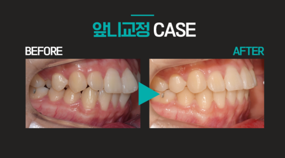강남 앞니 부분교정, 2년 걸리는 전체 교정 말고 관련 이미지 10