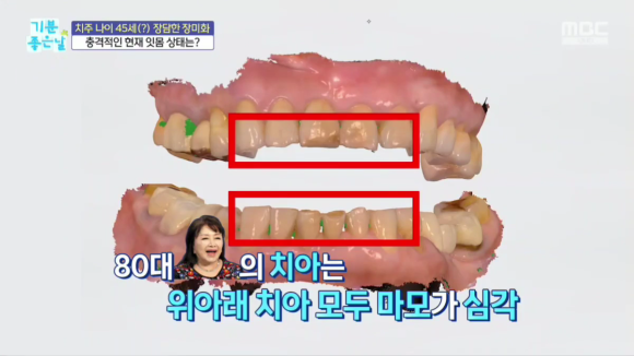 Recommended Endodontic Dentist in Gangnam: Don’t Put Off Treating Tooth Wear Any Longer image 3
