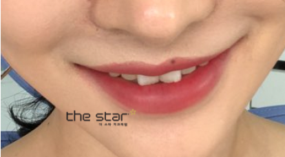 나비치아, 토끼 이빨 안 예쁜 앞니는 더스타치과 맞춤 라미네이트 관련 이미지 1