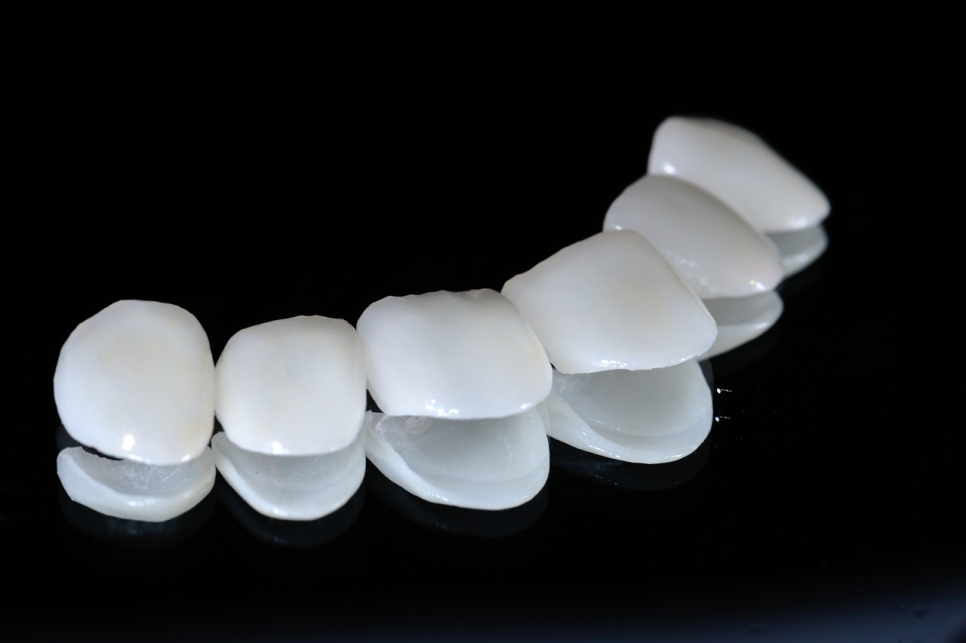 강남 라미네이트치과 선택, 세렉과 수작업방식에 대한 이해부터 관련 이미지 8