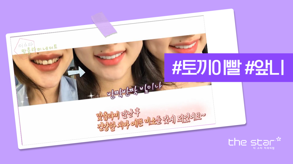 신사동 프리미엄 라미네이트 디테일 치료 과정 고민이시라면 더스타치과로 관련 이미지 3