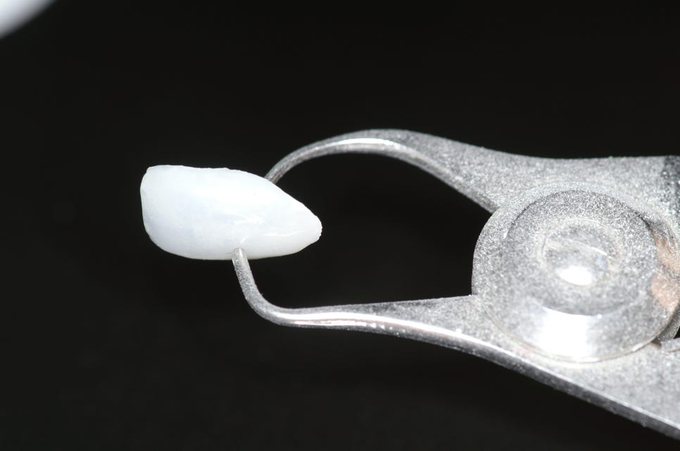 강남 라미네이트치과 선택의 기준, 더스타치과가 전하는 가격 너머의 이야기 관련 이미지 6