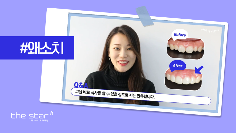 신사동 프리미엄 라미네이트 디테일 치료 과정 고민이시라면 더스타치과로 관련 이미지 2