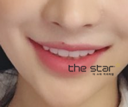 나비치아, 토끼 이빨 안 예쁜 앞니는 더스타치과 맞춤 라미네이트 관련 이미지 3