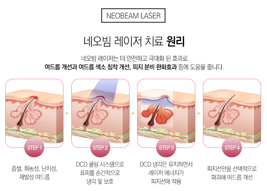 네오빔 근본적인 부분부터 관리하여 관련 이미지 6