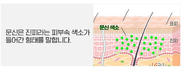 [서울대입구피부과] 깔끔하고 빠른 문신제거를 원한다면? 피코레이저! 관련 이미지 3