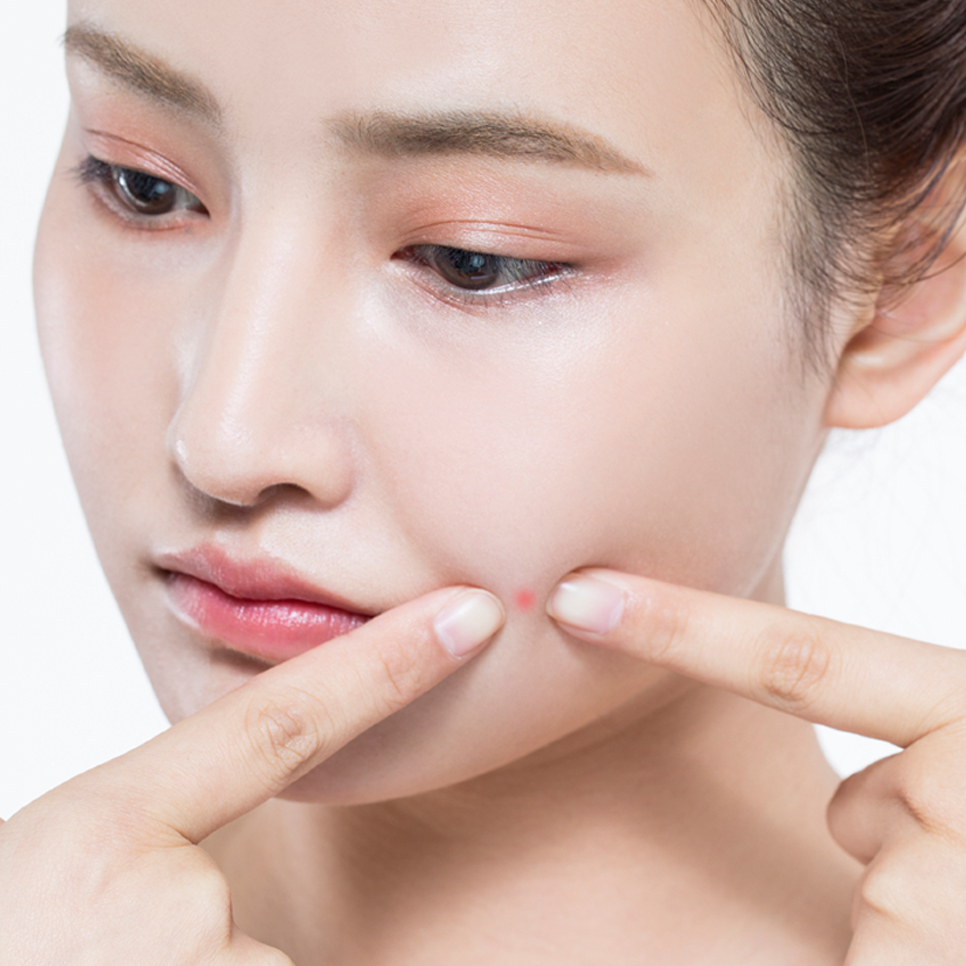 아그네스레이저 여드름치료 하세요 관련 이미지 1