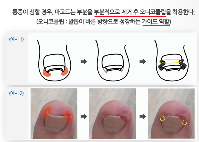 내향성손발톱 교정- 어렵지 않아요 관련 이미지 3