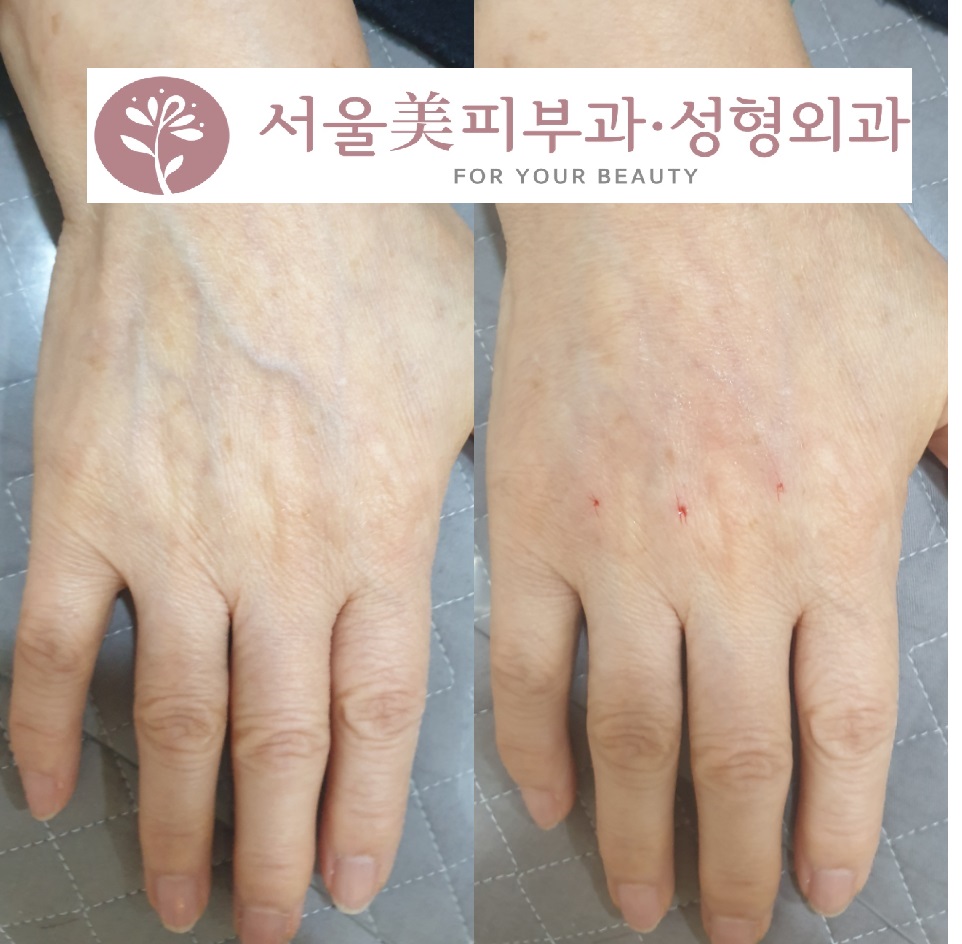 손등필러로 쭈글한 엄마손 10년 젊어지자 관련 이미지 1