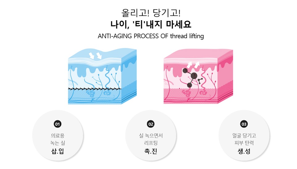 실리프팅으로 탄력 있게 팔자주름없애기 관련 이미지 5