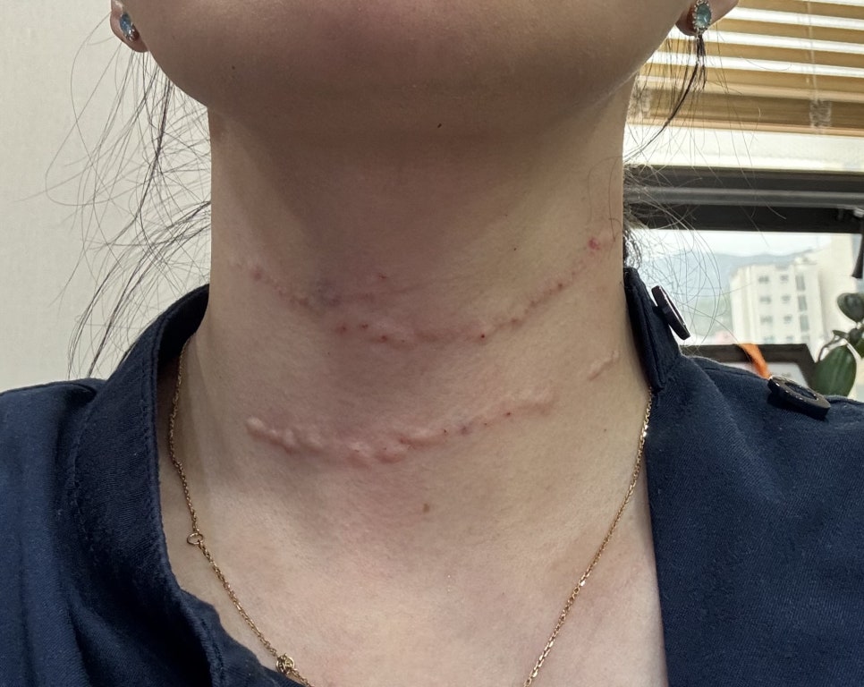 저도 이제 목주름이 생기네요??(전원장 목주름극뽁 프로젝트) 관련 이미지 3