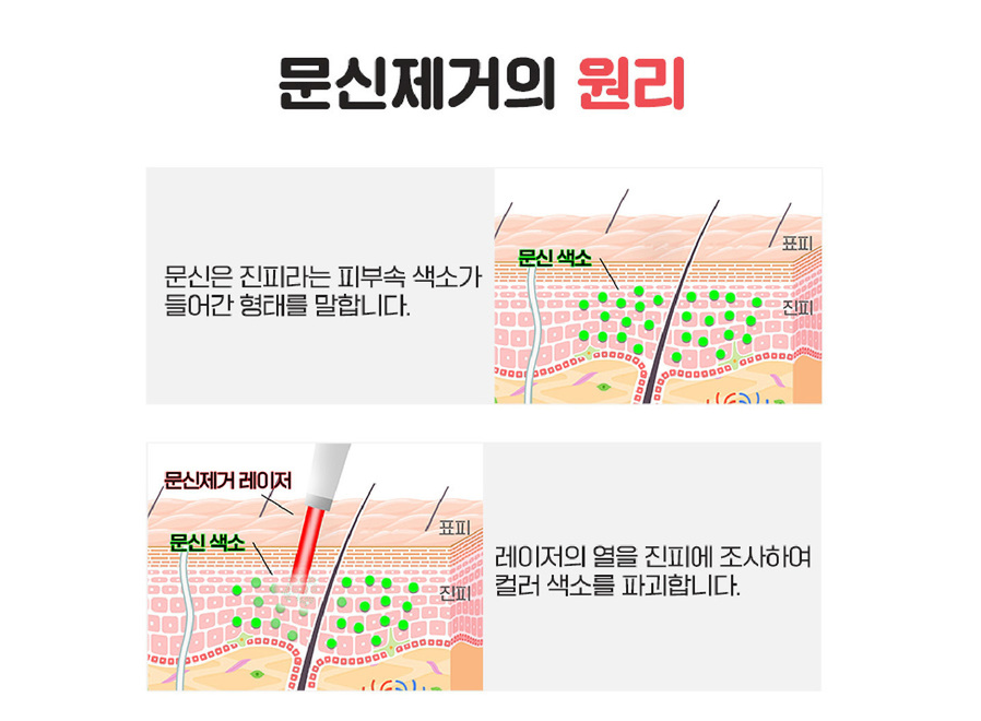 서울대입구문신제거 알아보고 있다면 관련 이미지 3