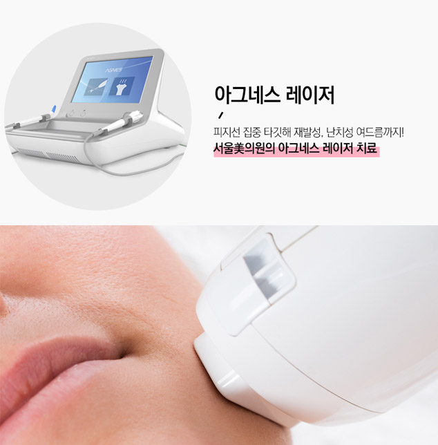 여드름 눈 밑 한관종 비립종 깨끗하게 없애는 법 아그네스 레이저 관련 이미지 3